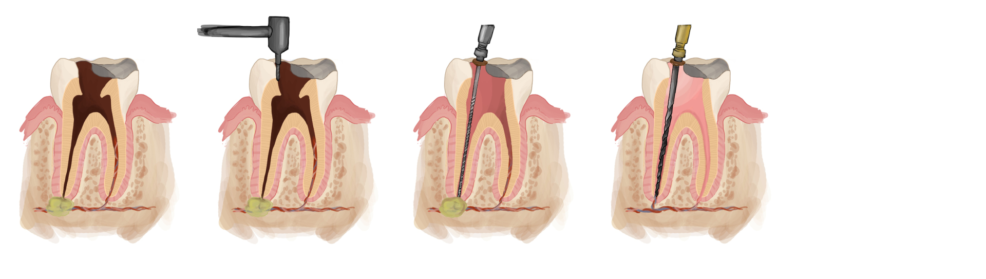 Gyokerkezeles - [:ro]tratament Endodontic[:hu]gyökérkezelés[:en]treatment 1[:]